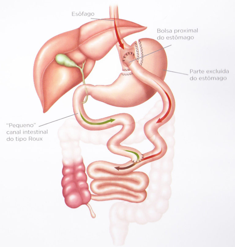 Bypass Gástrico Dr Claudio De Luca